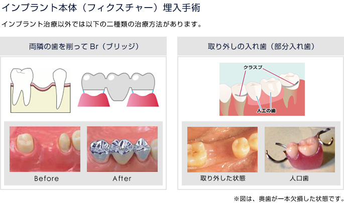 �ʏ�̃C���v�����g���Â̗���