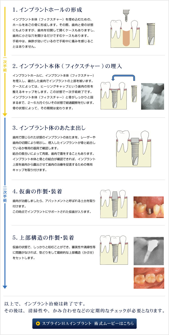 �ʏ�̃C���v�����g���Â̗���